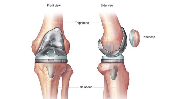 فیزیوتراپی بعد از تعویض مفصل زانو