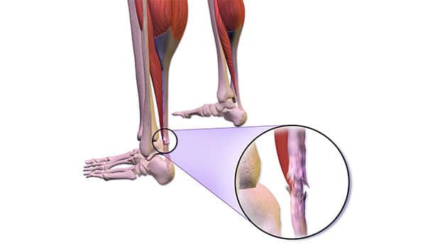پارگی تاندون آشیل پا